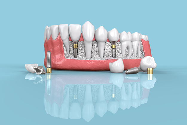 Dental implant model showing tooth replacement stages on blue background with instruments.