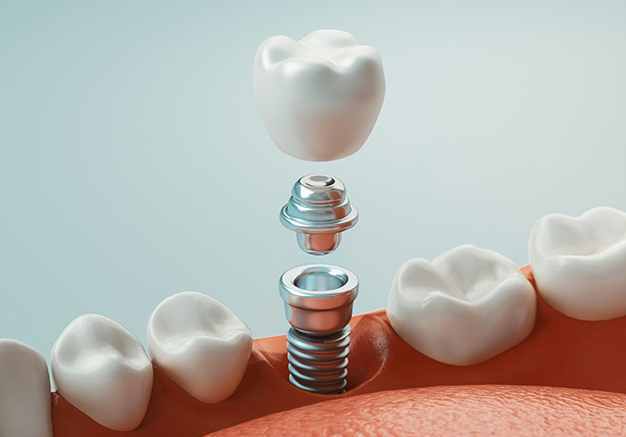 Dental implant cross-section showing crown, abutment, and screw components with tooth models on gum background.