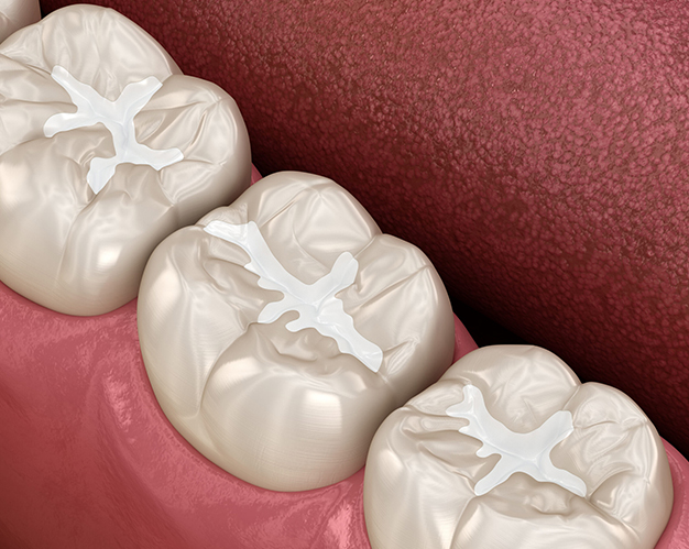 Three white dental crowns displayed on pink gum model showing restorative dentistry work.
