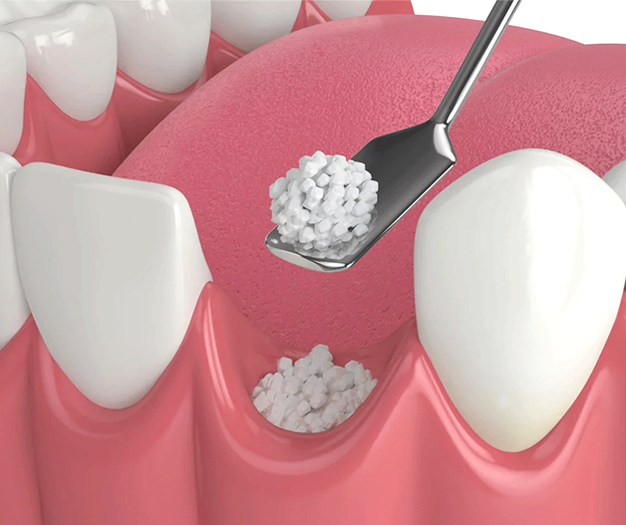 Dental illustration showing tooth implant procedure with bone graft material and surgical instruments on gum tissue.