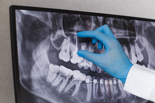 Dentist in blue glove examining dental X-ray on light box display.