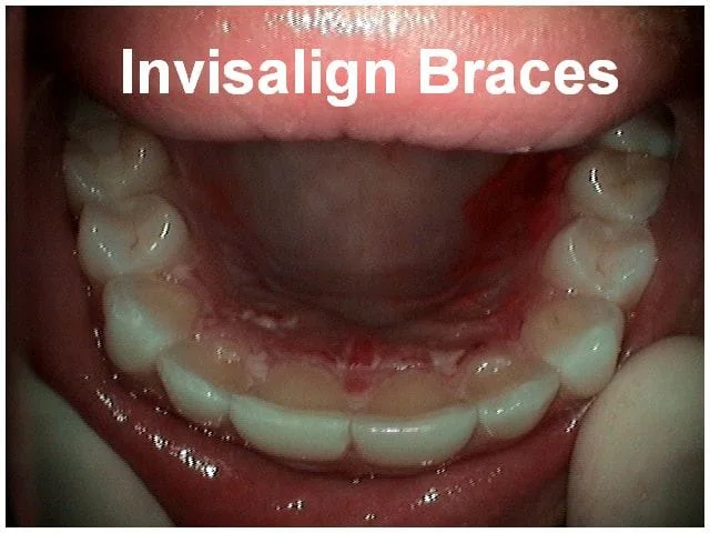 Invisalign braces shown on lower teeth inside open mouth during dental examination.