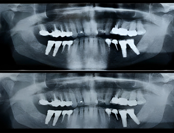 Panoramic dental X-rays showing upper and lower teeth with multiple implants before and after treatment.