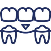 Three dental crowns above two teeth with bridge implant illustration.