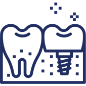 Dental implant illustration showing tooth replacement procedure with natural and implant teeth side by side.