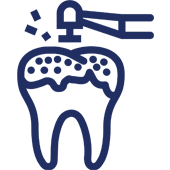 Tooth receiving dental treatment from overhead dental drill and water spray tool.